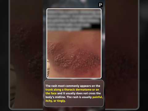 Extreme case of Herpes Zoster