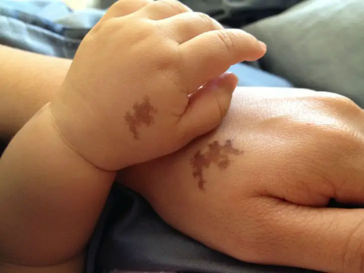 Tatuagem de marca de nascença