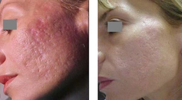fotos-de-cicatrizes-de-acne-antes-e-depois-laser