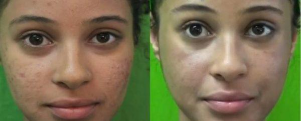 fotos-de-cicatrizes-de-acne-antes e depois da dermoabrasão