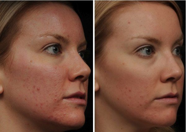 fotos-de-cicatrizes-de-acne-antes-e-depois-do-peeling químico