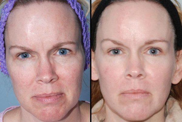 fotos-de-cicatrizes-de-acne-antes e depois da maquiagem