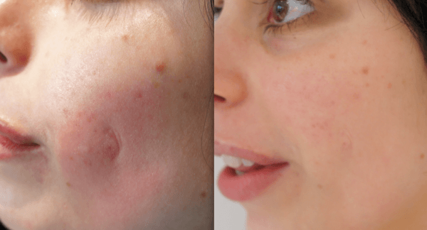 fotos-acne-cicatrizes-antes-e-depois